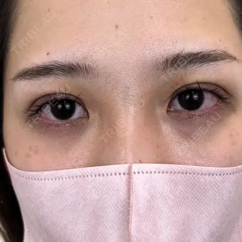 二重埋没 NARU Beauty Clinic 【ナルクリ】 DAY 0