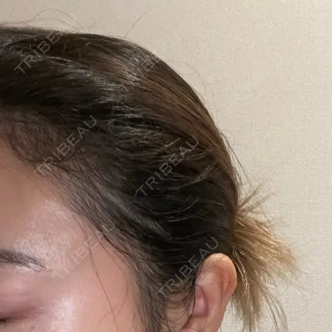 アートメイク（ヘアライン） トイトイトイクリニック 池袋院 AFTER