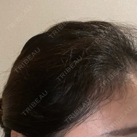アートメイク（ヘアライン） トイトイトイクリニック 池袋院 AFTER