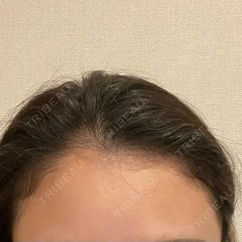 アートメイク（ヘアライン） トイトイトイクリニック 池袋院 AFTER