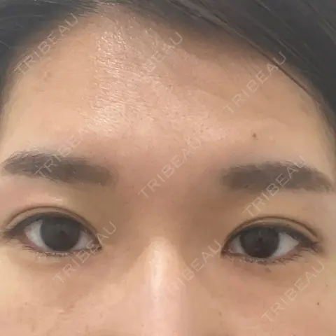 二重埋没 湘南美容クリニック 上野院 DAY 11
