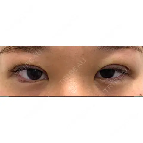二重埋没 / 上まぶたの脂肪取り / 自然癒着法 NARU Beauty Clinic 【ナルクリ】 DAY 0