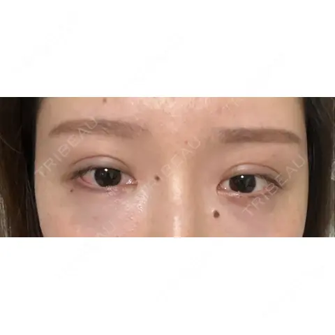 二重埋没 / 下まぶたたるみ取り アリエル美容クリニック 大宮院 DAY 0
