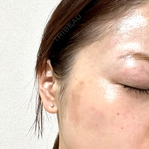 ピコレーザートーニング（美白・肝斑） NOVUSBeautyClinic 新宿ラウンジ AFTER