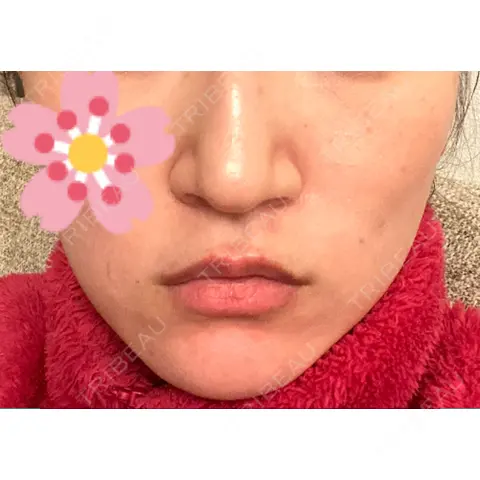 ボトックス（口角） / ボトックス（人中） S-Laboクリニック 渋谷院 DAY 0