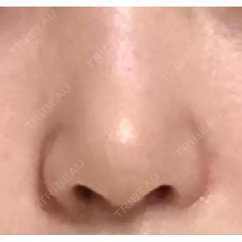鼻尖形成（切開） / 軟骨移植 JUN CLINIC AFTER