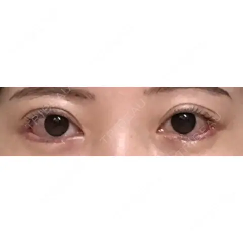 目尻切開 / タレ目形成・グラマラスライン（切開） JUN CLINIC AFTER