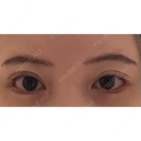 目尻切開 / タレ目形成・グラマラスライン（切開） JUN CLINIC AFTER