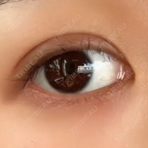 二重埋没 NARU Beauty Clinic 【ナルクリ】 AFTER