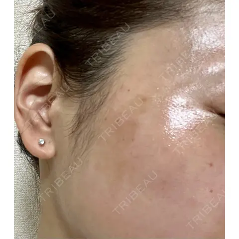ピコレーザートーニング（美白・肝斑） NOVUSBeautyClinic 新宿ラウンジ AFTER