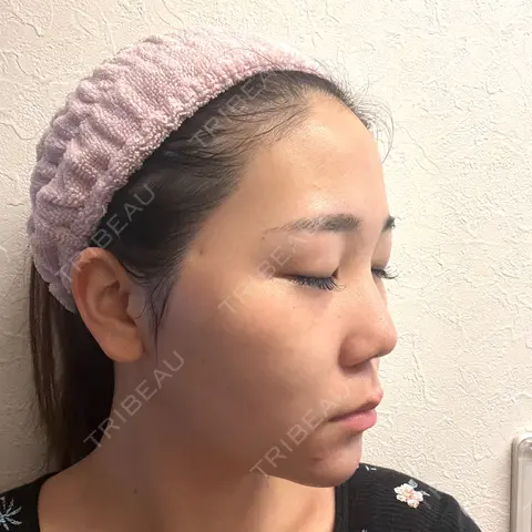 クマ治療 / 額を丸く / 下まぶたたるみ取り / 脂肪注入（額） / 脂肪注入（輪郭） 湘南美容クリニック 品川院 AFTER