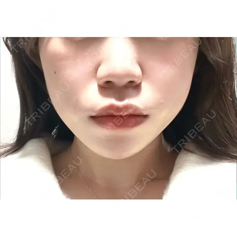 糸リフト / ヒアルロン酸注入（あご） / ボトックス（エラ・小顔） AI Beauty Clinic （エーアイ美容クリニック） DAY 0