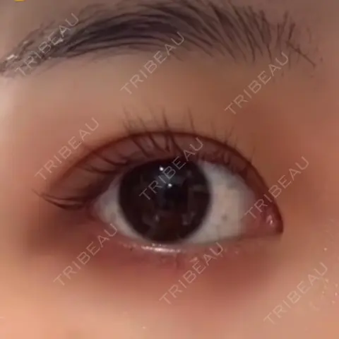 二重埋没 NARU Beauty Clinic 【ナルクリ】 AFTER
