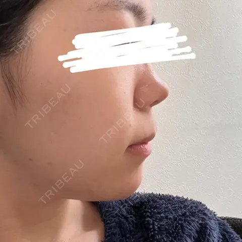 糸リフト / バッカルファット除去 / 脂肪吸引（顔） / ヒアルロン酸注入（あご） / ボトックス（エラ・小顔） アリエル美容クリニック 大宮院 AFTER