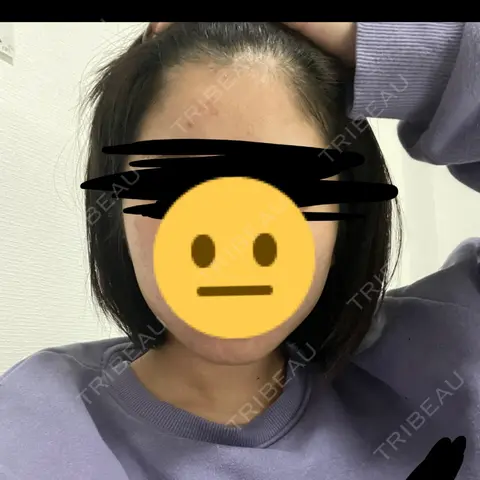 脂肪吸引（顔） ルラ美容クリニック 大阪本院 AFTER