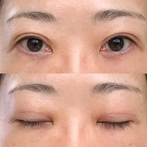 二重切開 / 上まぶたたるみ取り / PRP皮膚再生療法 BRIGHTS beauty clinic AFTER