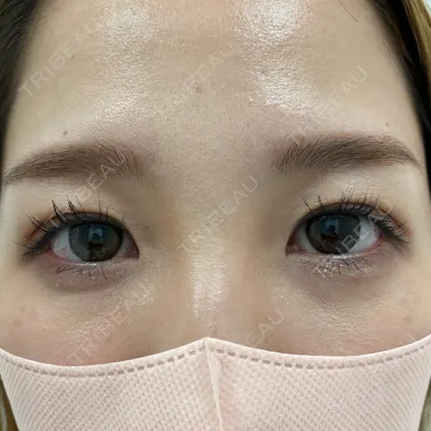 二重埋没 NARU Beauty Clinic 【ナルクリ】 AFTER