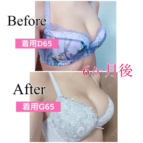 豊胸（シリコンバッグ） / 胸修正 / その他（胸） 渋谷の森クリニック AFTER