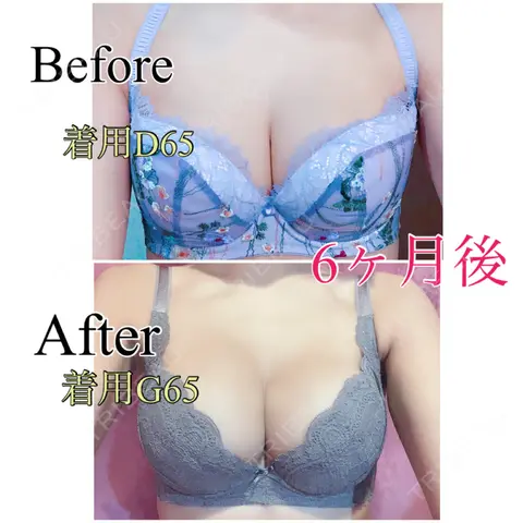 豊胸（シリコンバッグ） / 胸修正 / その他（胸） 渋谷の森クリニック AFTER