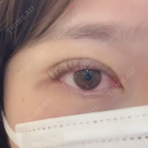 二重埋没 よだ形成外科クリニック DAY 0