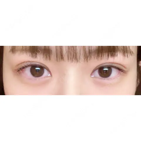 二重埋没 湘南美容クリニック 池袋東口院 AFTER