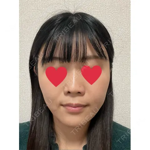 小鼻縮小（非切開） T CLINIC 新宿院 DAY 0