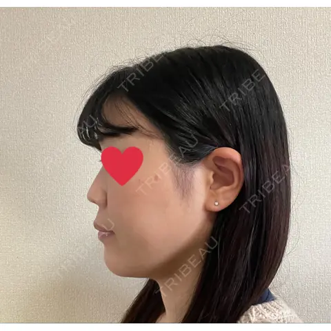 ハイフ（顔） ルネッサンス美容外科医院 青山本院 AFTER