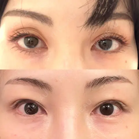 二重埋没 / 眼瞼下垂（非切開） フェアクリニック川口 DAY 0