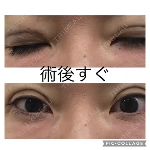 二重埋没 / クマ治療 / 脂肪注入（目の下） アリエル美容クリニック 大宮院 DAY 0