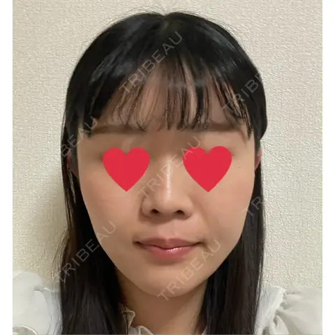 小鼻縮小（非切開） T CLINIC 新宿院 AFTER