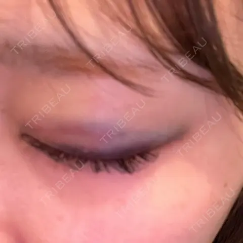 二重埋没 HAAB×DREAM BEAUTY CLINIC 東京本院 DAY 1