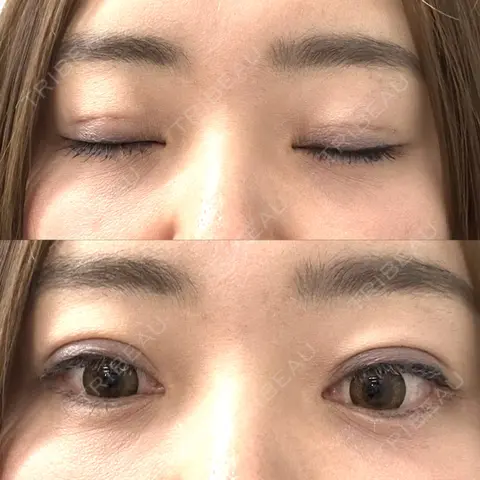 二重埋没 / クマ治療 藤・ナチュレ美容クリニック 恵比寿院 AFTER