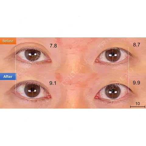 眼瞼下垂（非切開） SOL CLINIC AFTER