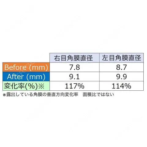 眼瞼下垂（非切開） SOL CLINIC AFTER