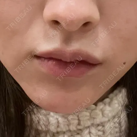 脂肪溶解注射（顔） あいち栄クリニック DAY 0