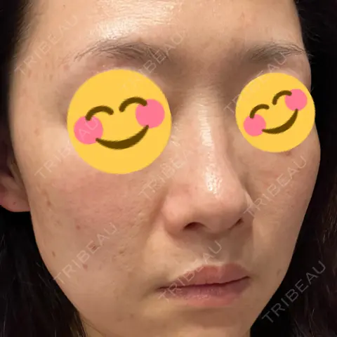 ピーリング（ニキビ・毛穴） / 毛穴洗浄（ハイドラフェイシャルなど） KARIS beauty clinic AFTER