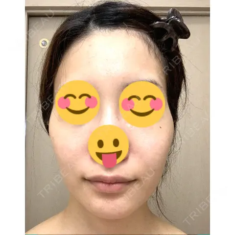 糸リフト 湘南美容クリニック 南青山院 DAY 0