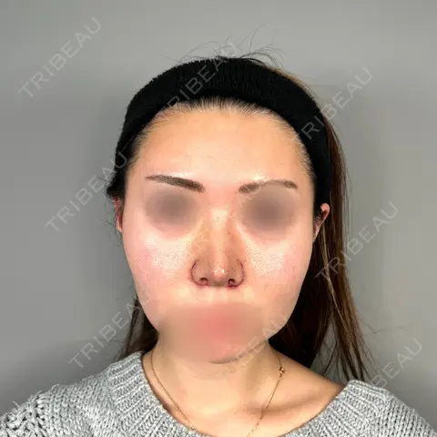 鼻尖形成（切開） / 小鼻縮小（切開） / 軟骨移植 ASTRA BEAUTY CLINIC AFTER