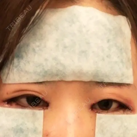 目頭切開 / 目尻切開 / 水光注射（ハリ・美肌） エートップ美容整形外科 DAY 0
