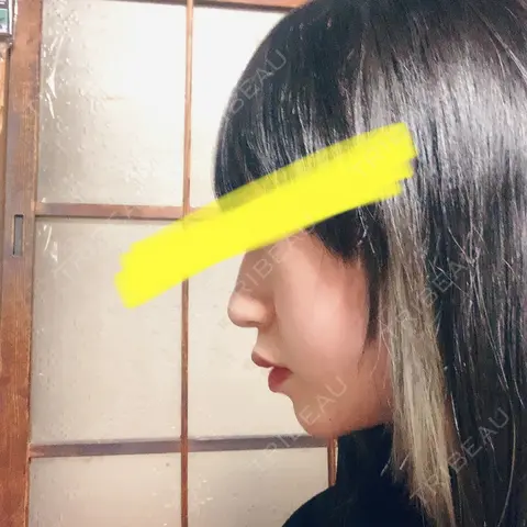 下まぶたたるみ取り / ヒアルロン酸注入（あご） / ボトックス（エラ・小顔） コスメディカルクリニック シンシア 銀座院 AFTER