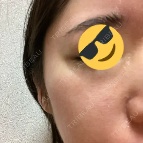 シミ取りレーザー / ピコレーザートーニング（美白・肝斑） Olino美容外科・美容皮膚科 AFTER