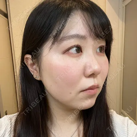 ほくろ・いぼ除去レーザー（肌） / ピコスポット Fellez Clinic【フェルズクリニック】 AFTER