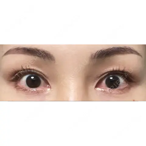二重埋没 / 眼瞼下垂（非切開） フェアクリニック川口 AFTER
