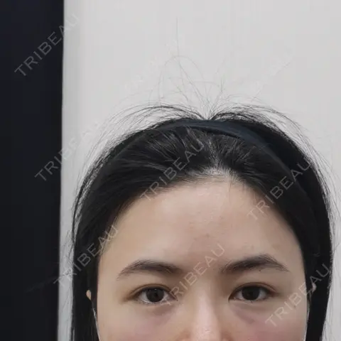 クマ治療 / 下まぶたの脂肪取り / 脂肪注入（目の下） セオリークリニック DAY 0