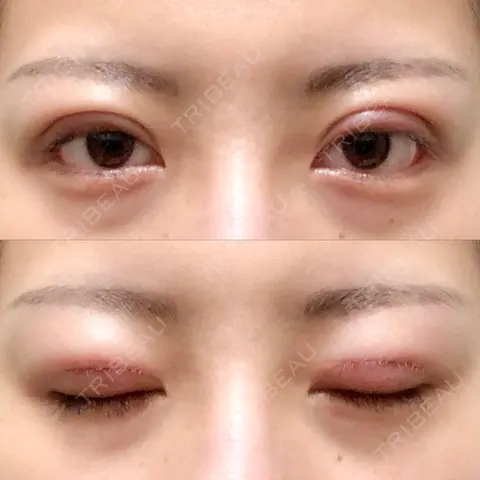 二重切開 ルネッサンス美容外科医院 青山本院 DAY 0