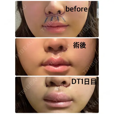 人中短縮 聖心美容クリニック 六本木院 DAY 1