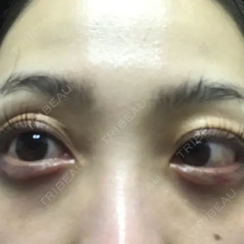 ヒアルロン酸注入（涙袋） AI Beauty Clinic （エーアイ美容クリニック） DAY 0