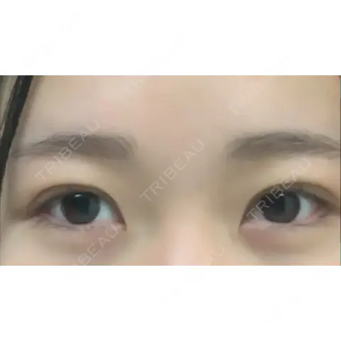 二重埋没 T CLINIC 新宿院 DAY 0