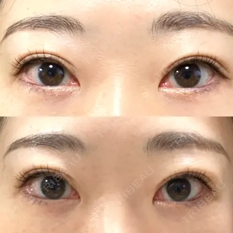 二重切開 / 上まぶたたるみ取り / PRP皮膚再生療法 BRIGHTS beauty clinic AFTER