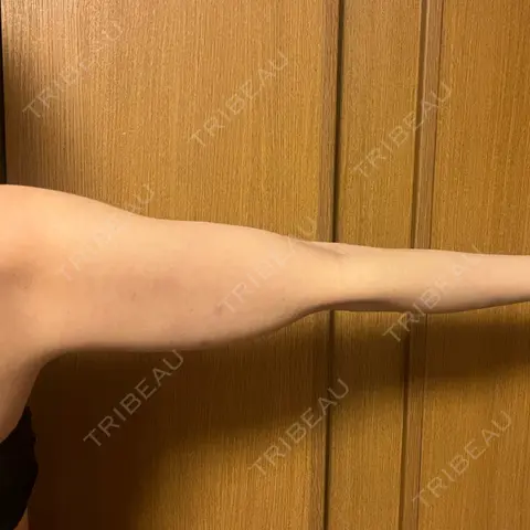 脂肪冷却（二の腕） みずほクリニック DAY 1